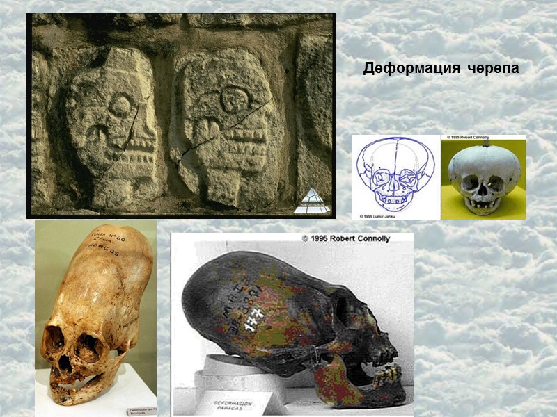 Деформация черепа